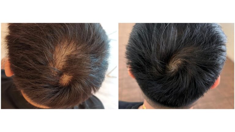 A Real Hair Growth Story: How Our 27-Year-Old Client Regained Fuller, Stronger Hair